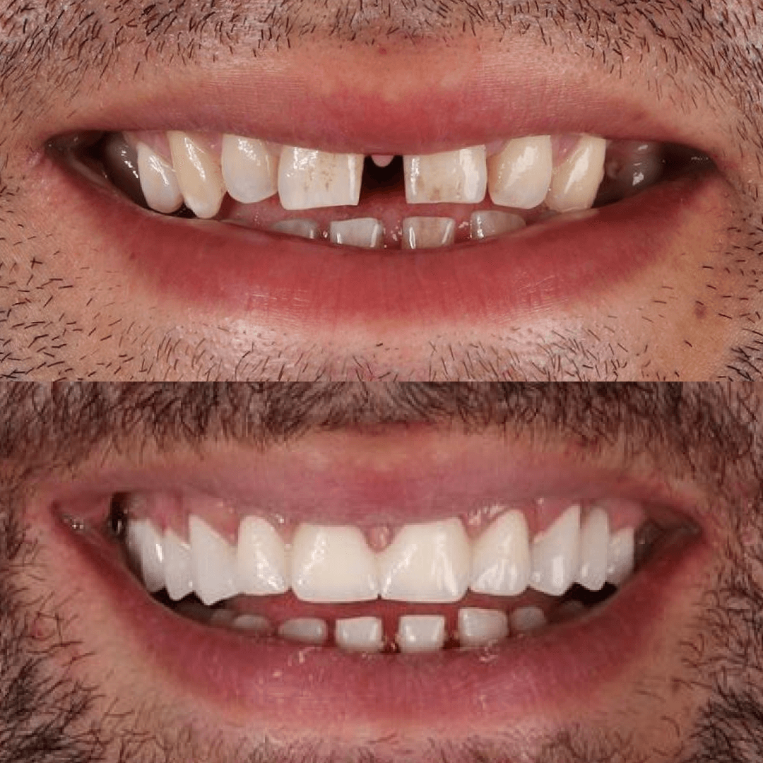 Zirconium crowns in Turkey