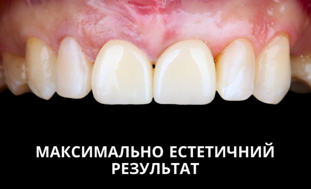 Керамічні вініри