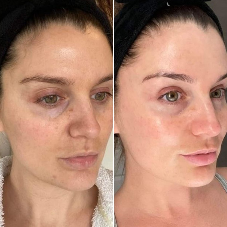 Przed i po stosowaniu serum ARGIRELINE® — Marta, 45 lat