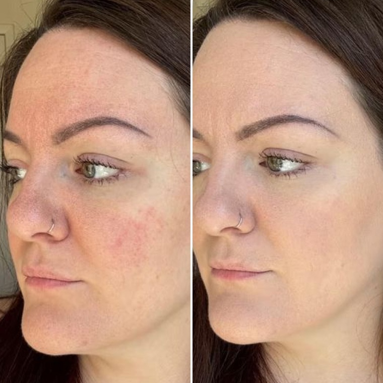 Ірина — до і після використання Ceramide Complex+
