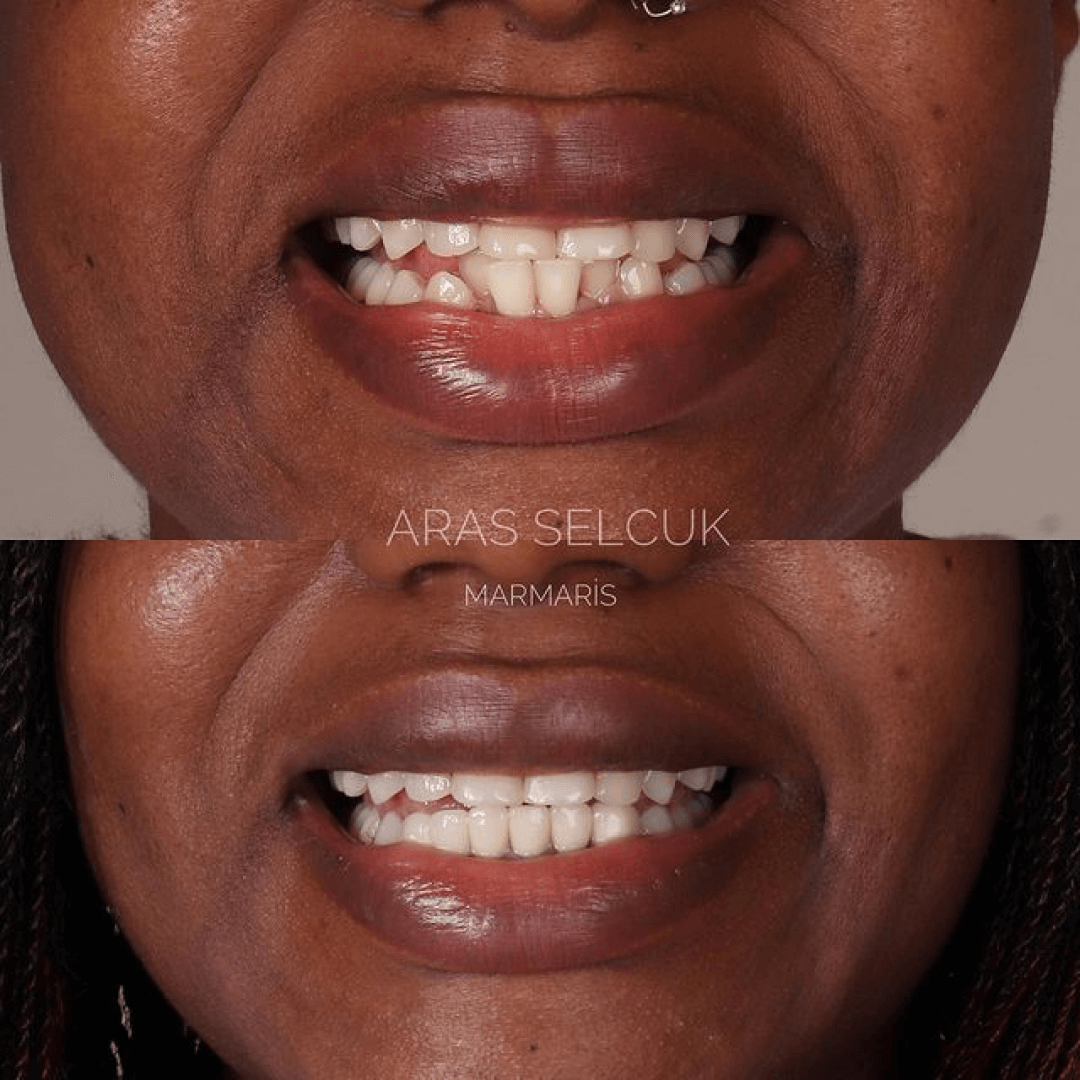 Before after Marmaris