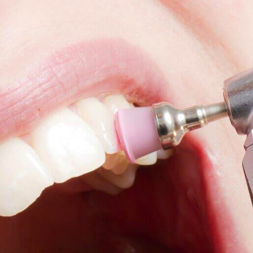 Профессиональная чистка зубов