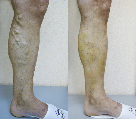 Endovenoz lazer