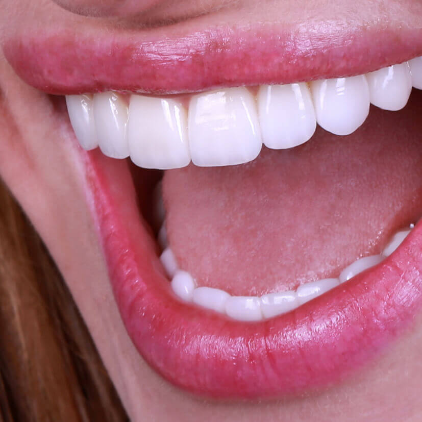 Винир, коронка, вкладка. Керамическая реставрация