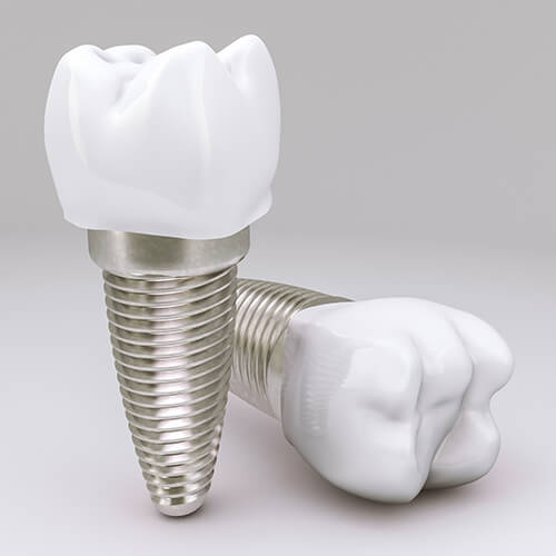dental implants