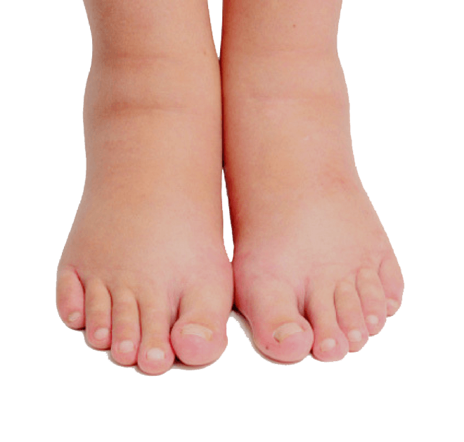 Ayaqlarda olan şişkinliyinin Damar Corabları ilə müalicəsi