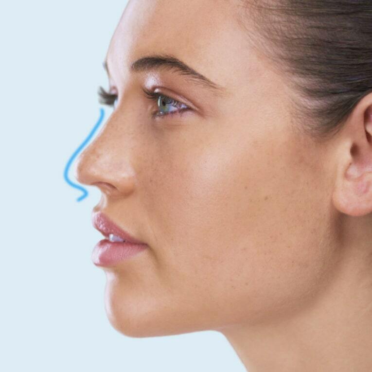 Ринопластика пластична хірургія носа