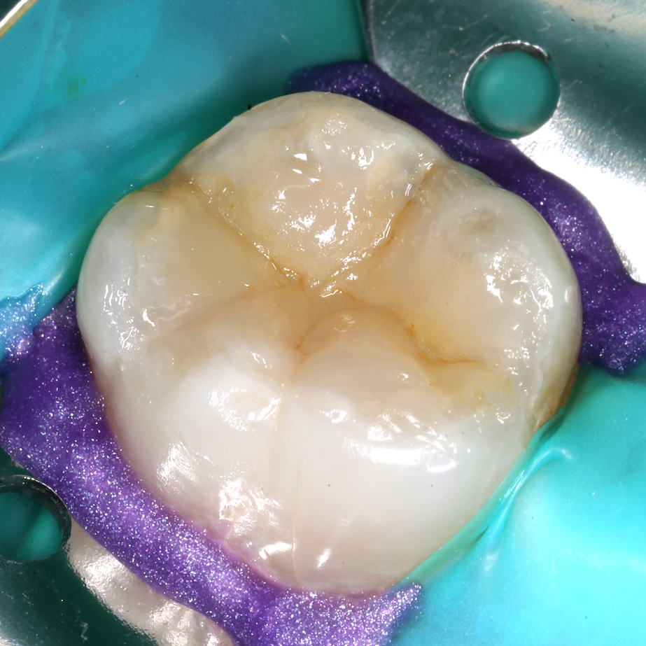 Лечение кариеса