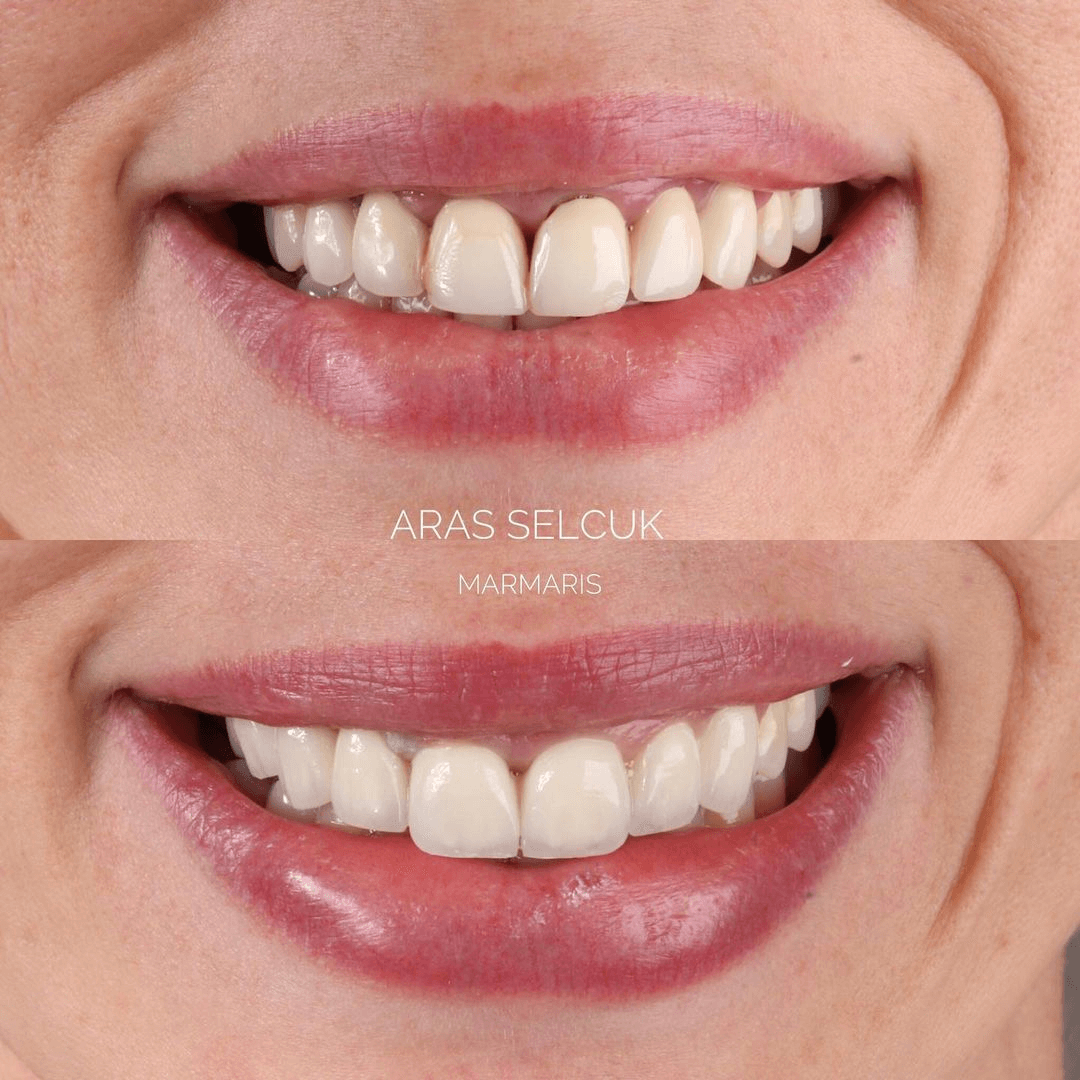 Porcelain crowns Marmaris