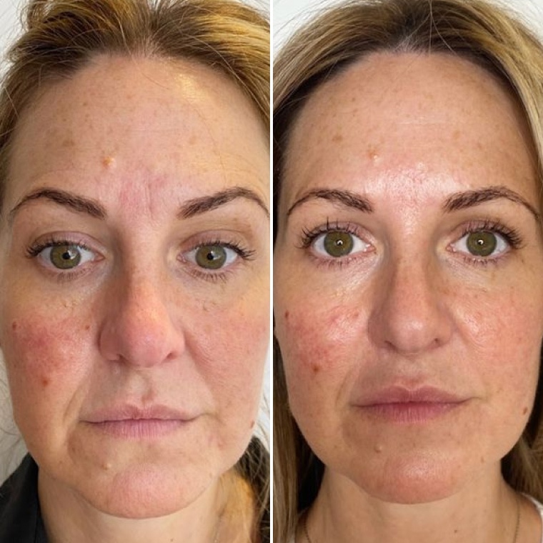 Олена — до і після використання Ceramide Complex+
