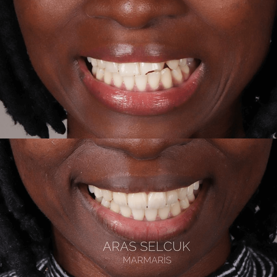 Before after zirconium crowns