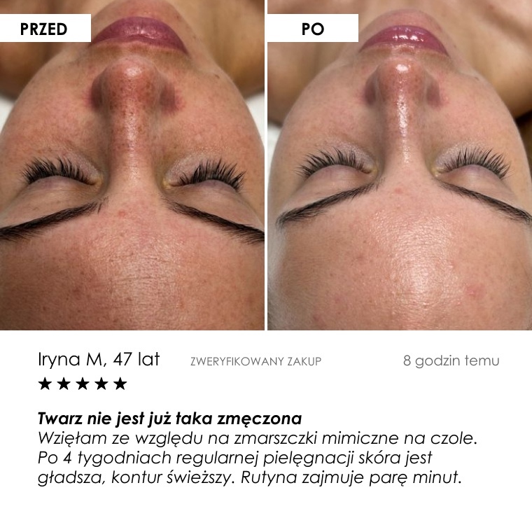 Przed i po: Iryna M., 47 — opinia klientki