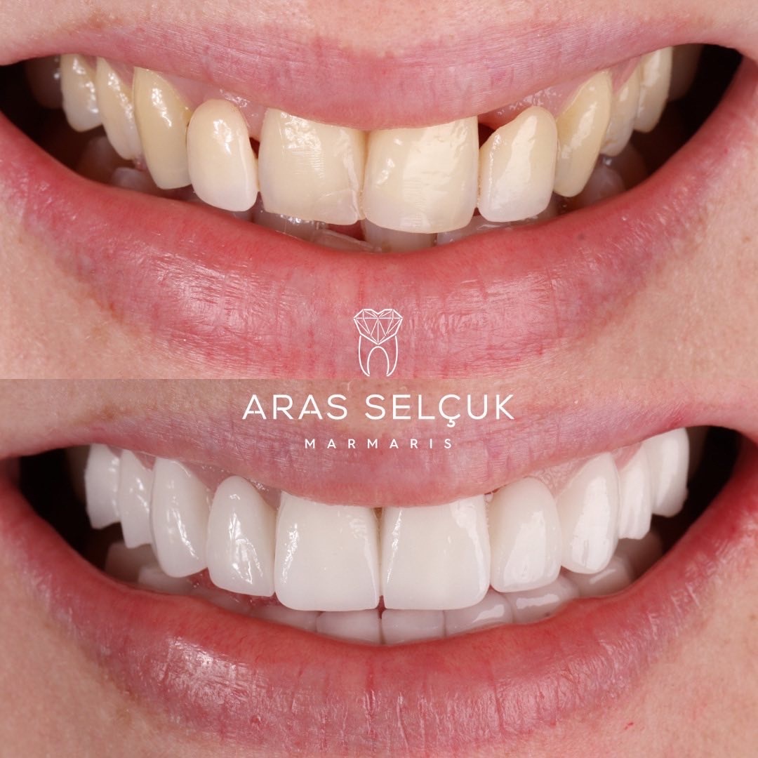 smile makeover zirconium crown 