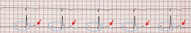 Abb. 4. EKG-Bild zeigt erhöhtes PR-Intervall