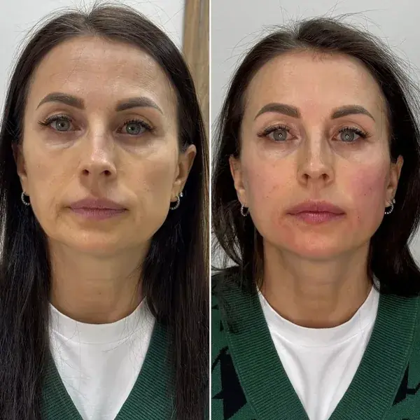 до та після — Ірина, 47