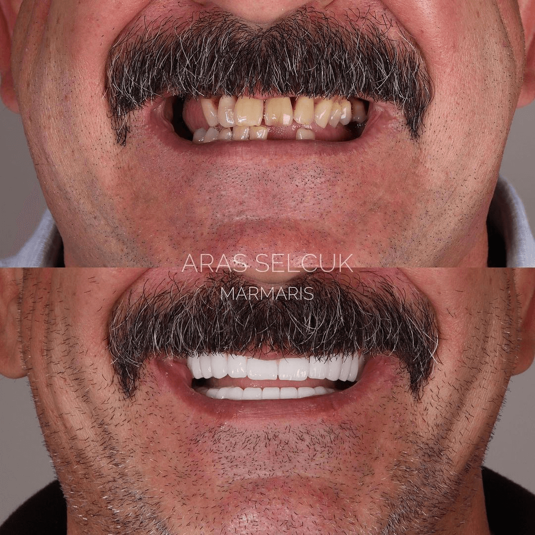 implant and zirconium crown Marmaris