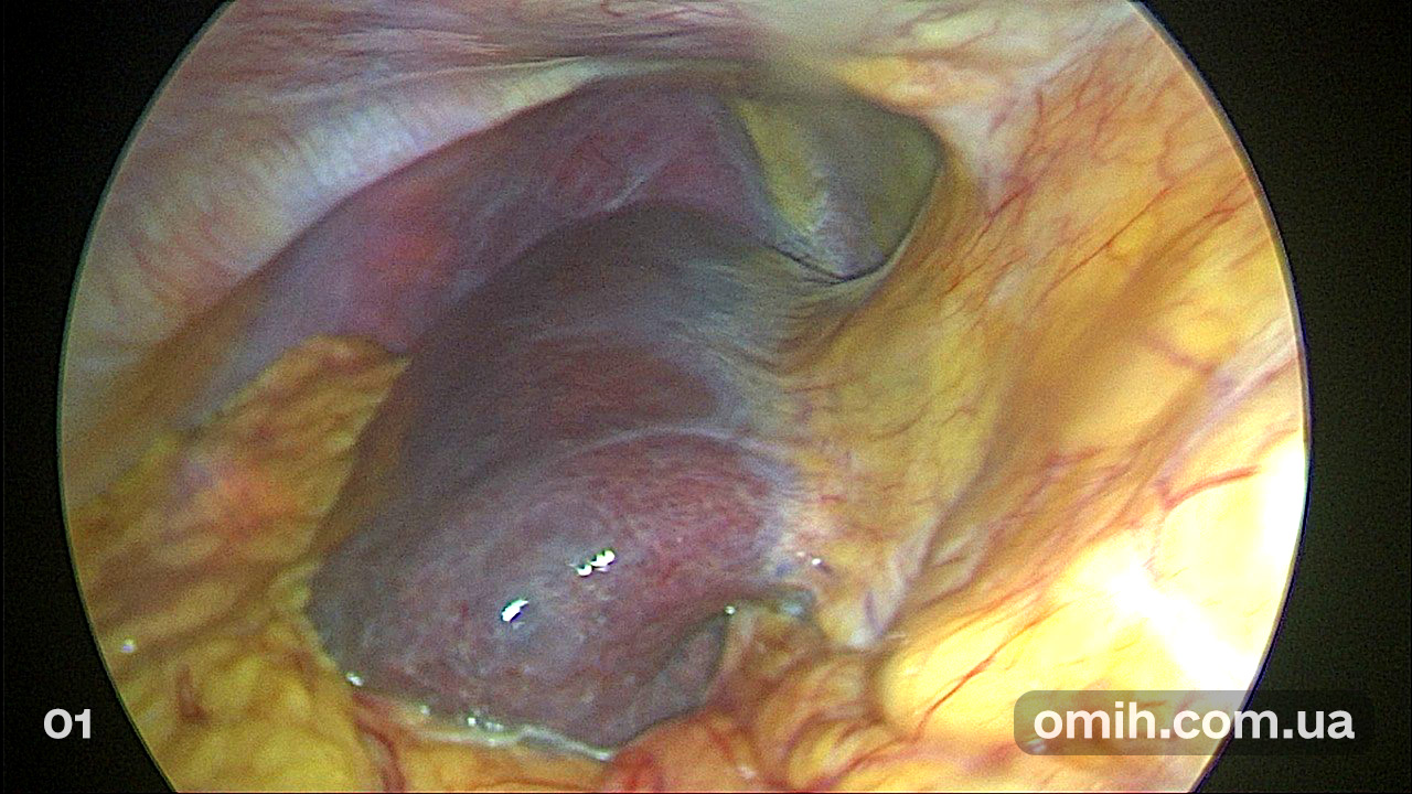 Субтотальная лапароскопическая холецистэктомия в Харькове — Лапароскопия в  ОМИХ