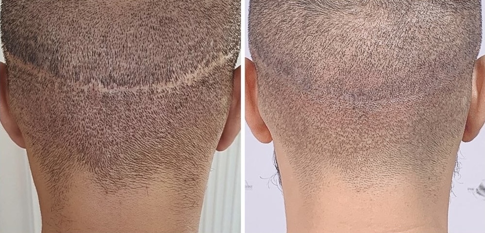Before Scar Camouflage SMP