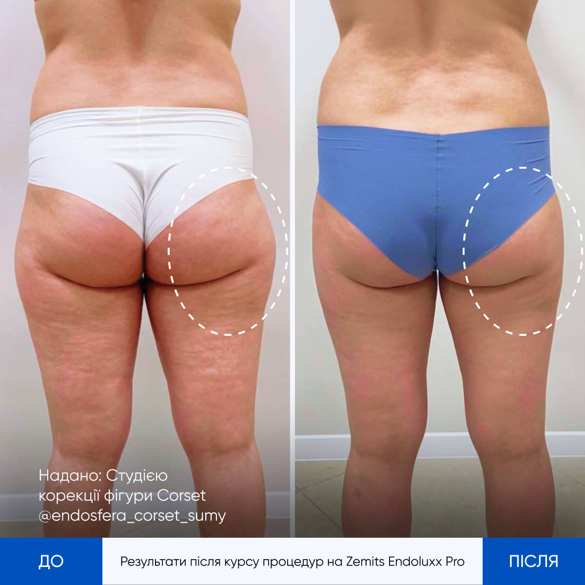 Zemits EndoLuxx PRO Апарат 3D скульптурування тіла та обличчя