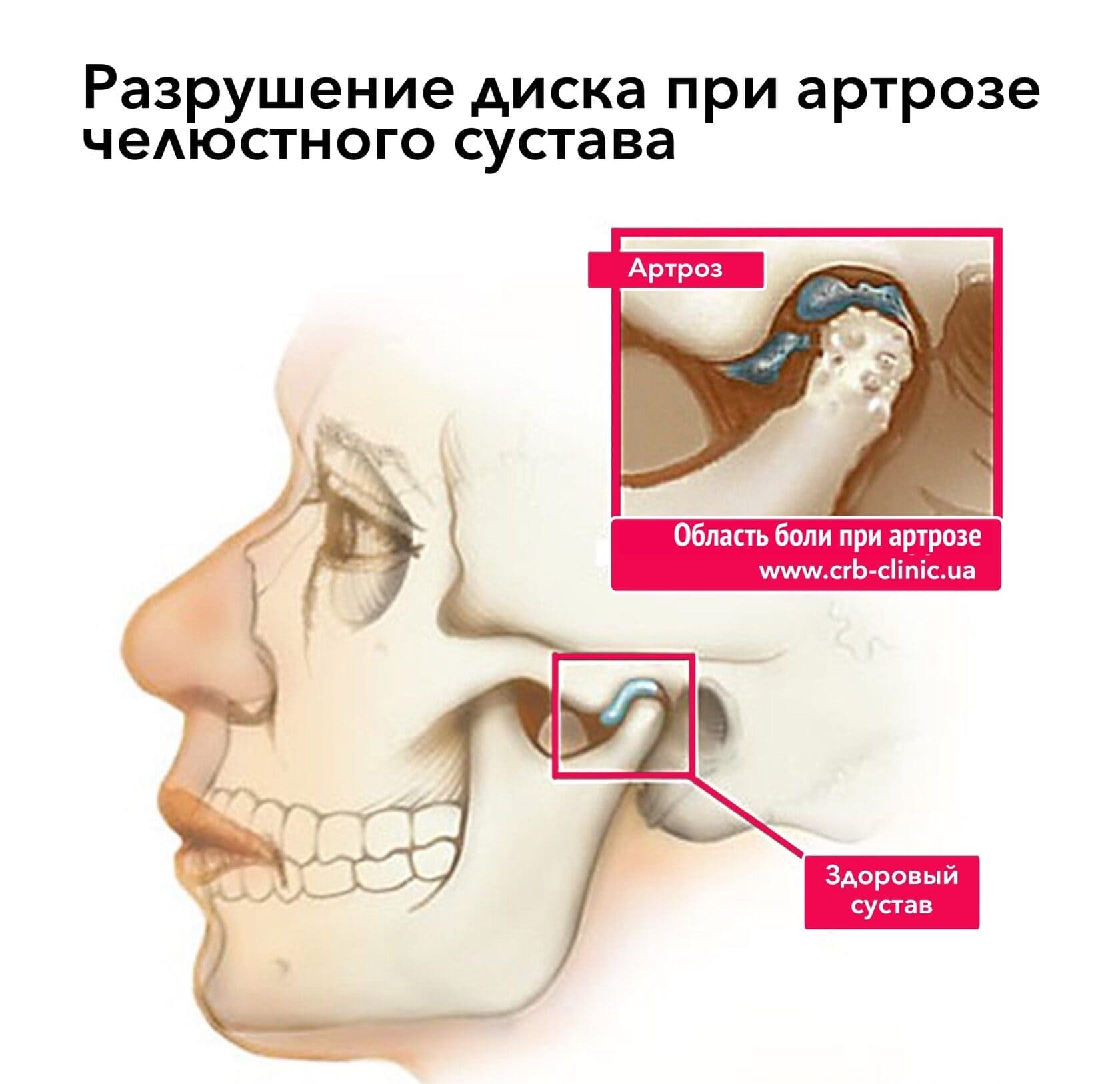 Боль в челюстном суставе. Лечение дисфункции ВНЧС