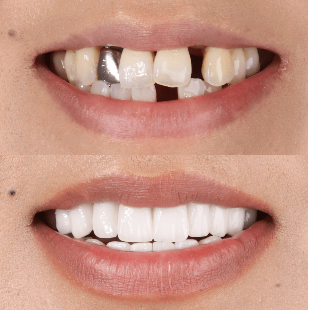 Emax veneers in Marmaris