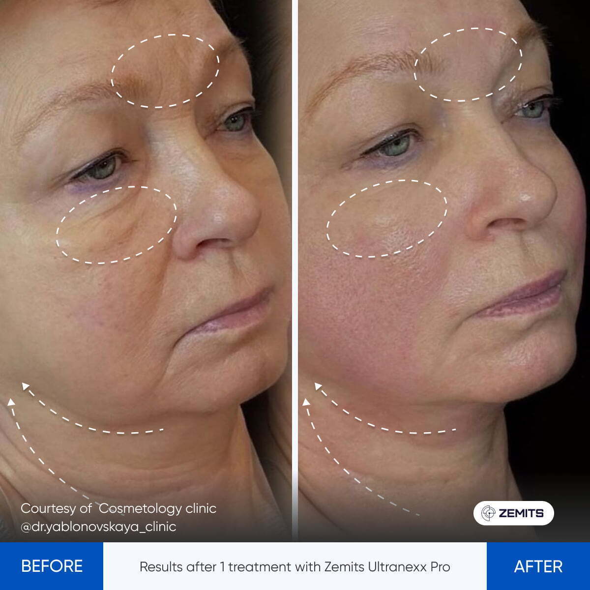 Zemits UltraNexx Pro HIFU 3D Smas lifting machine for skin tightening