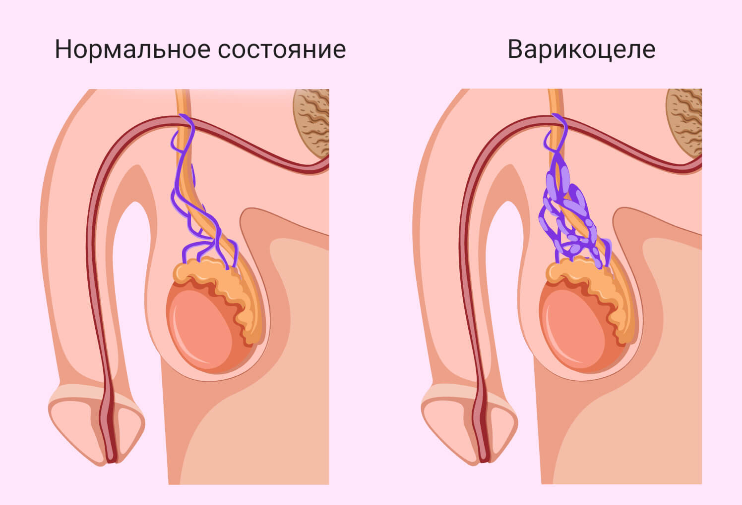 Операция при варикоцеле в Москве, цена в GMS ЭКО